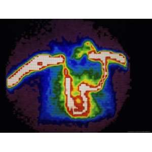  Nuclear Medicine Gamma Camera Scan Showing Occlusion of 