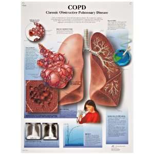  Glossy Laminated Paper Copd Chronic Obstructive Pulmonary Disease 