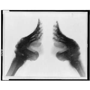  X ray of bound feet,China